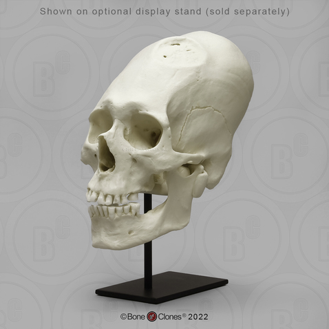 Peruvian Male Skull with Cranial Binding and Trephination Peruvian Male Skull with Cranial Binding and Trephination
