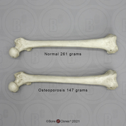 Human Adult Female Femur, Osteoporosis Comparative Set