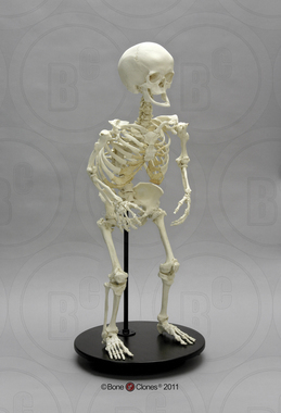 Human Female Achondroplasia Dwarf Skeleton, Articulated