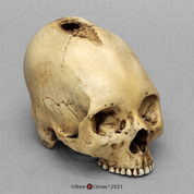 Human Trephined Skull Human Trephined Skull