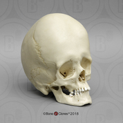 Human Male Hydrocephalic Skull